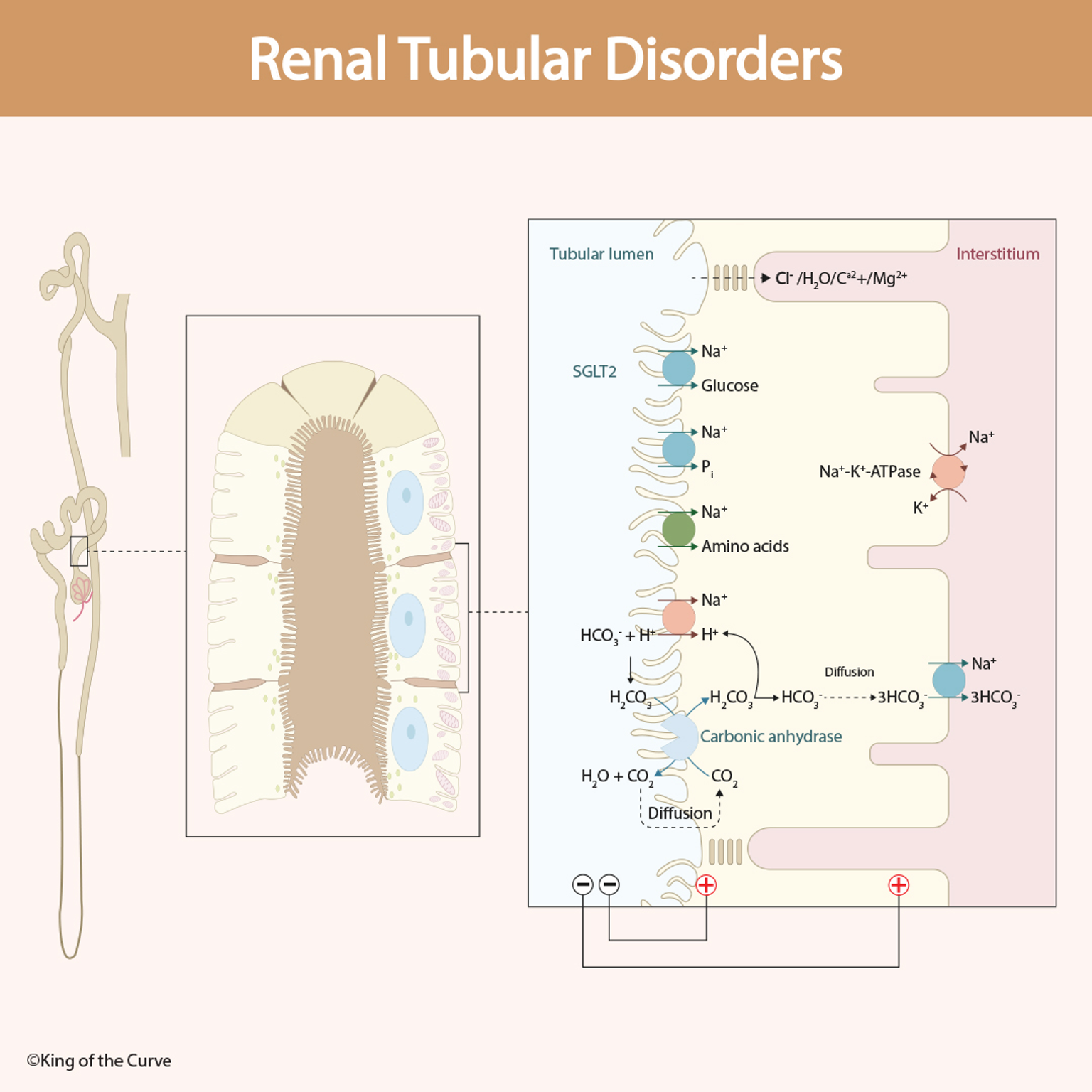 🩺 Renal Tubular Disorders: Understanding Proximal Tubule Dysfunction