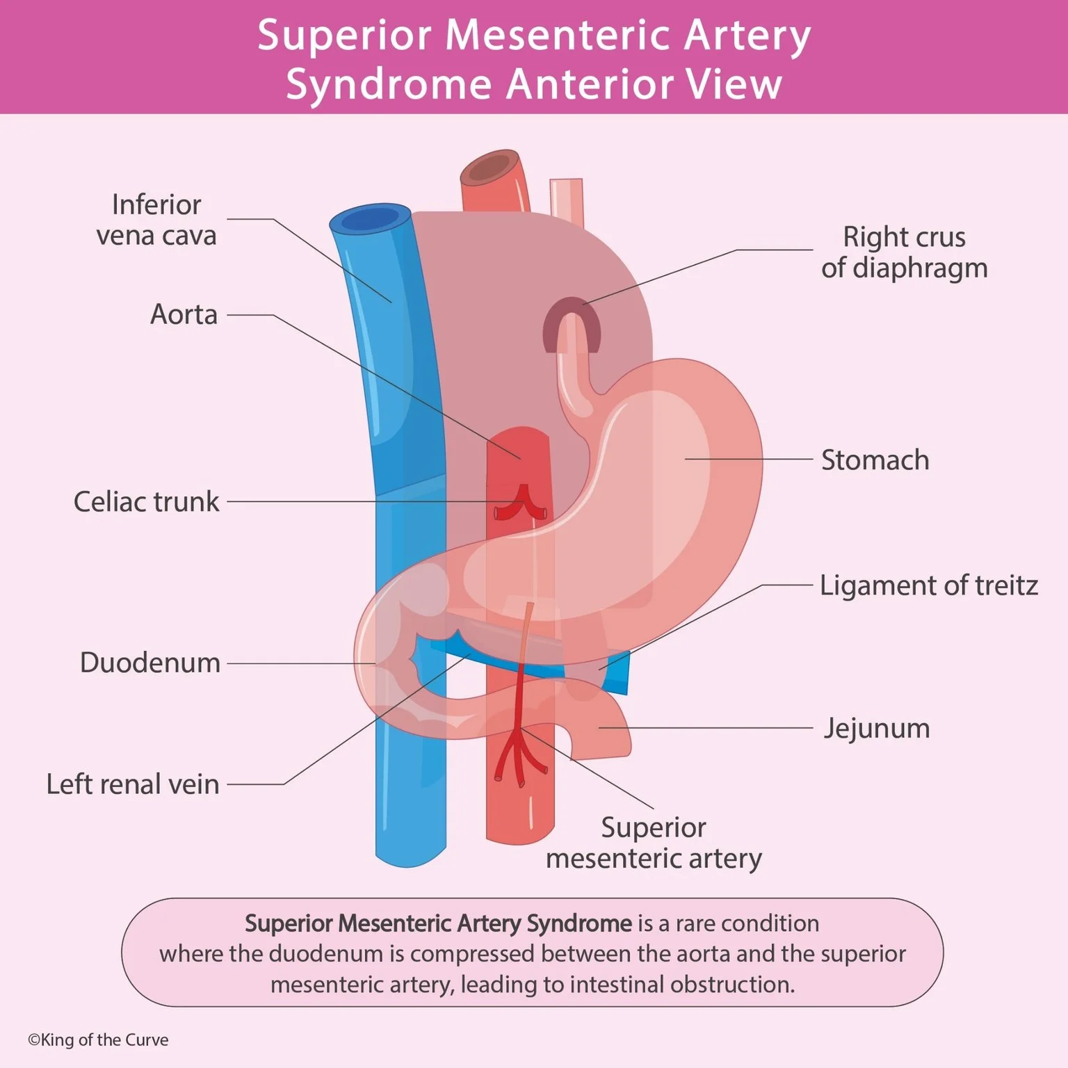 🩺 Superior Mesenteric Artery Syndrome: Anatomy, Compression, and Clinical Features