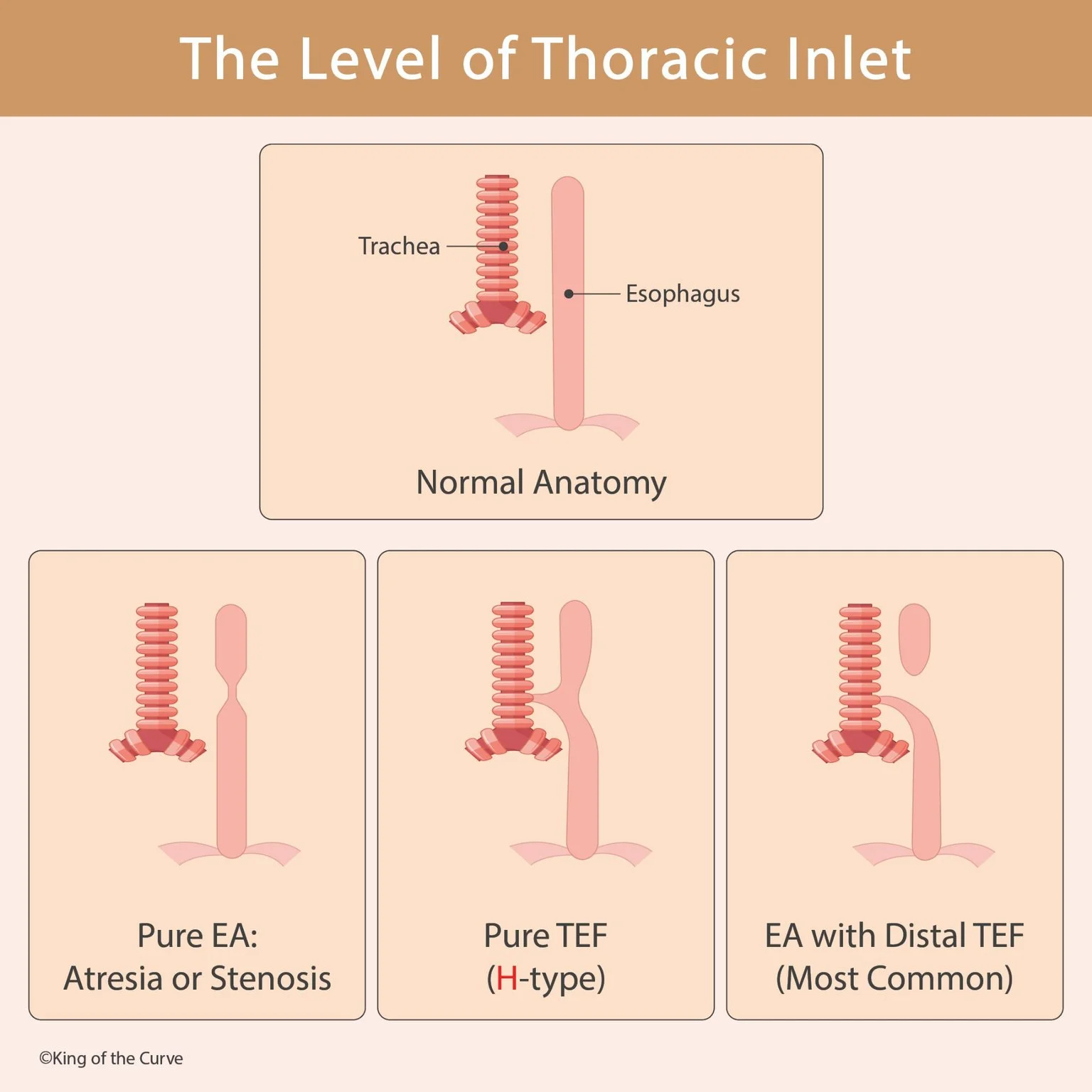 🫁 Esophageal Atresia and Tracheoesophageal Fistula