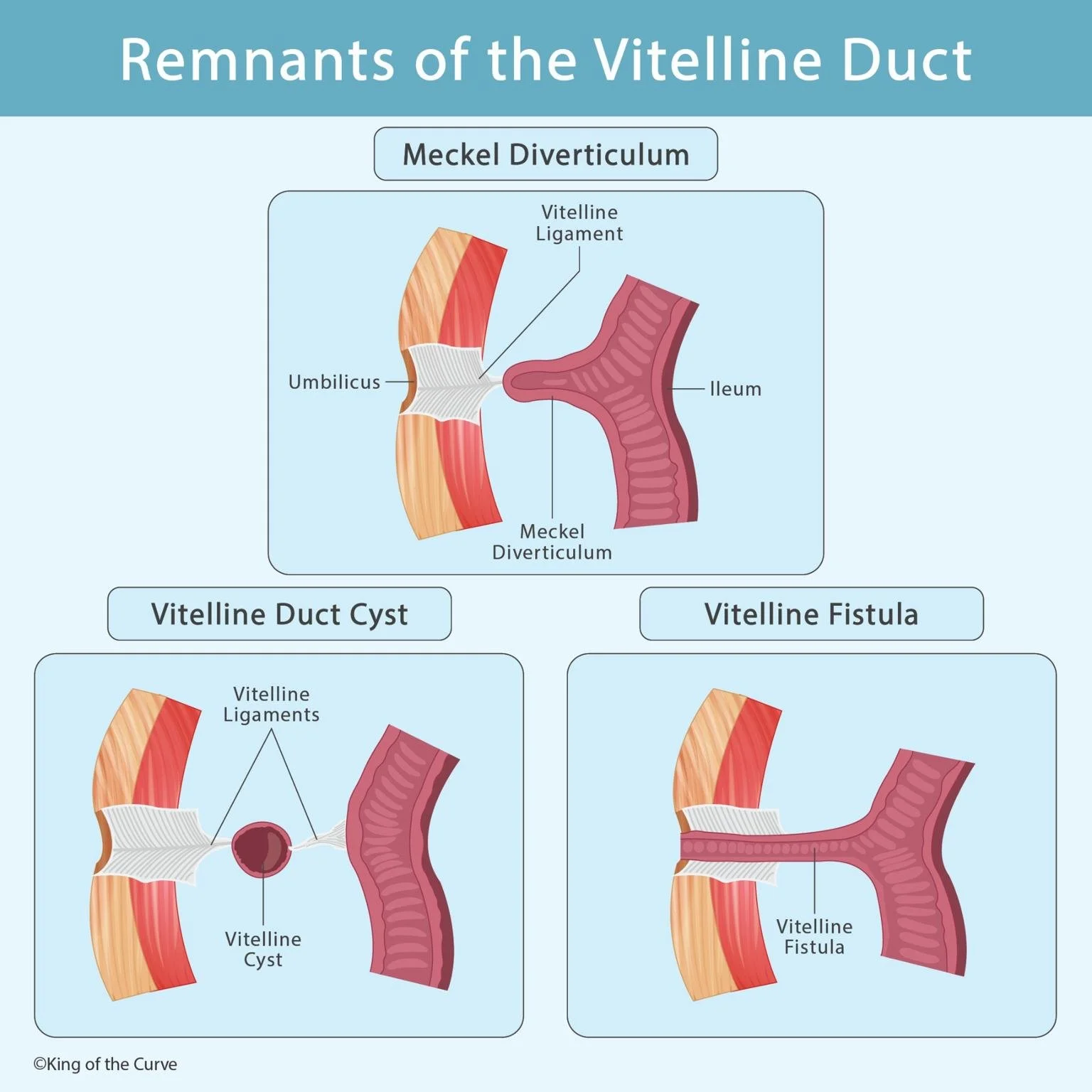 🧬 Understanding Vitelline Duct Remnants for the MCAT