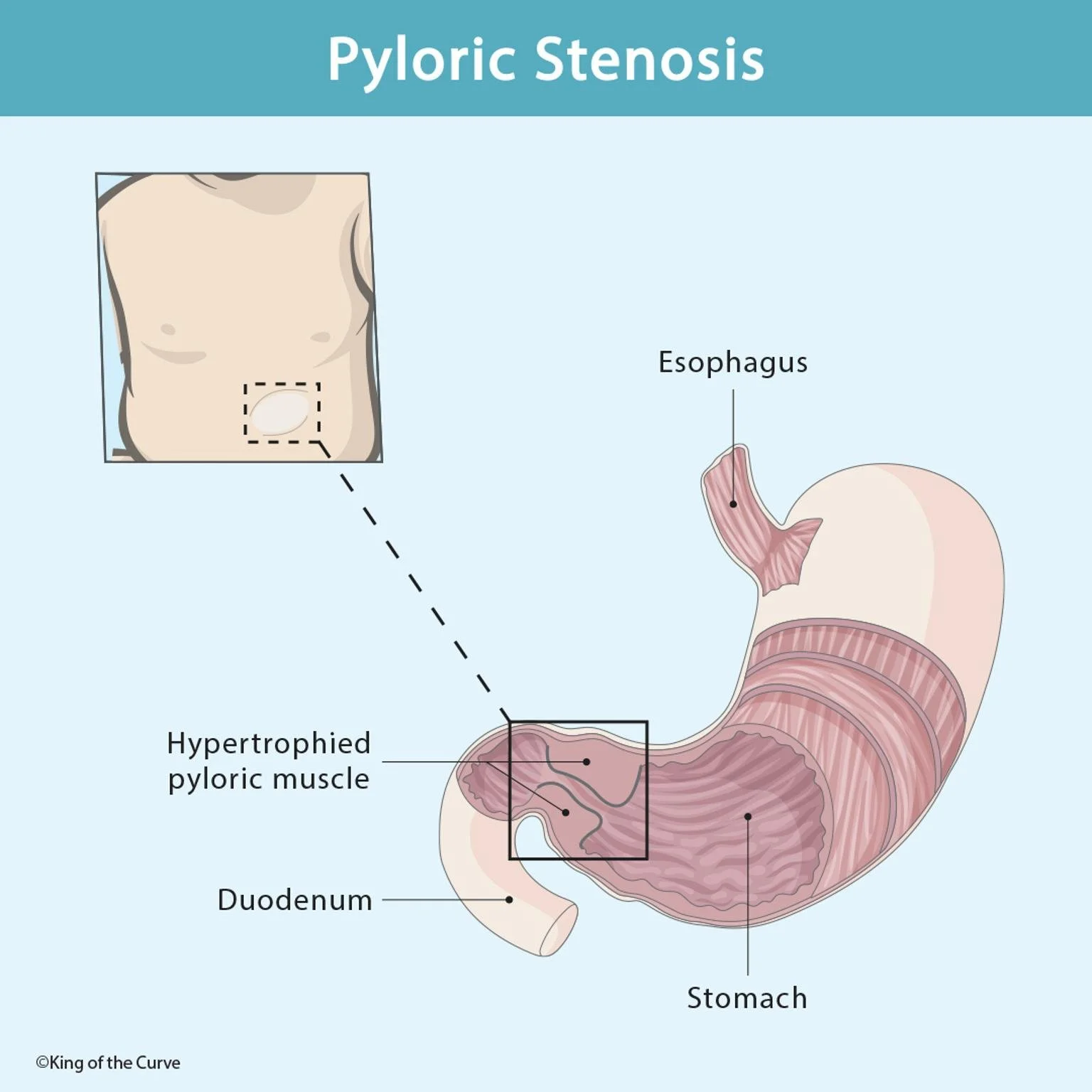 🧠 Understanding Pyloric Stenosis for the MCAT