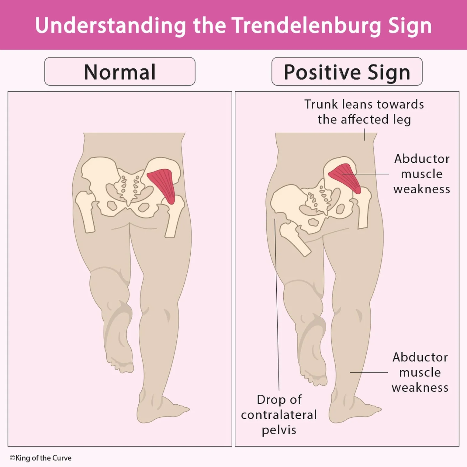 🦵 Understanding the Trendelenburg Sign (Normal vs Positive)