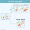 Annular Pancreas: Developmental Anomaly & MCAT High-Yield Facts — King ...