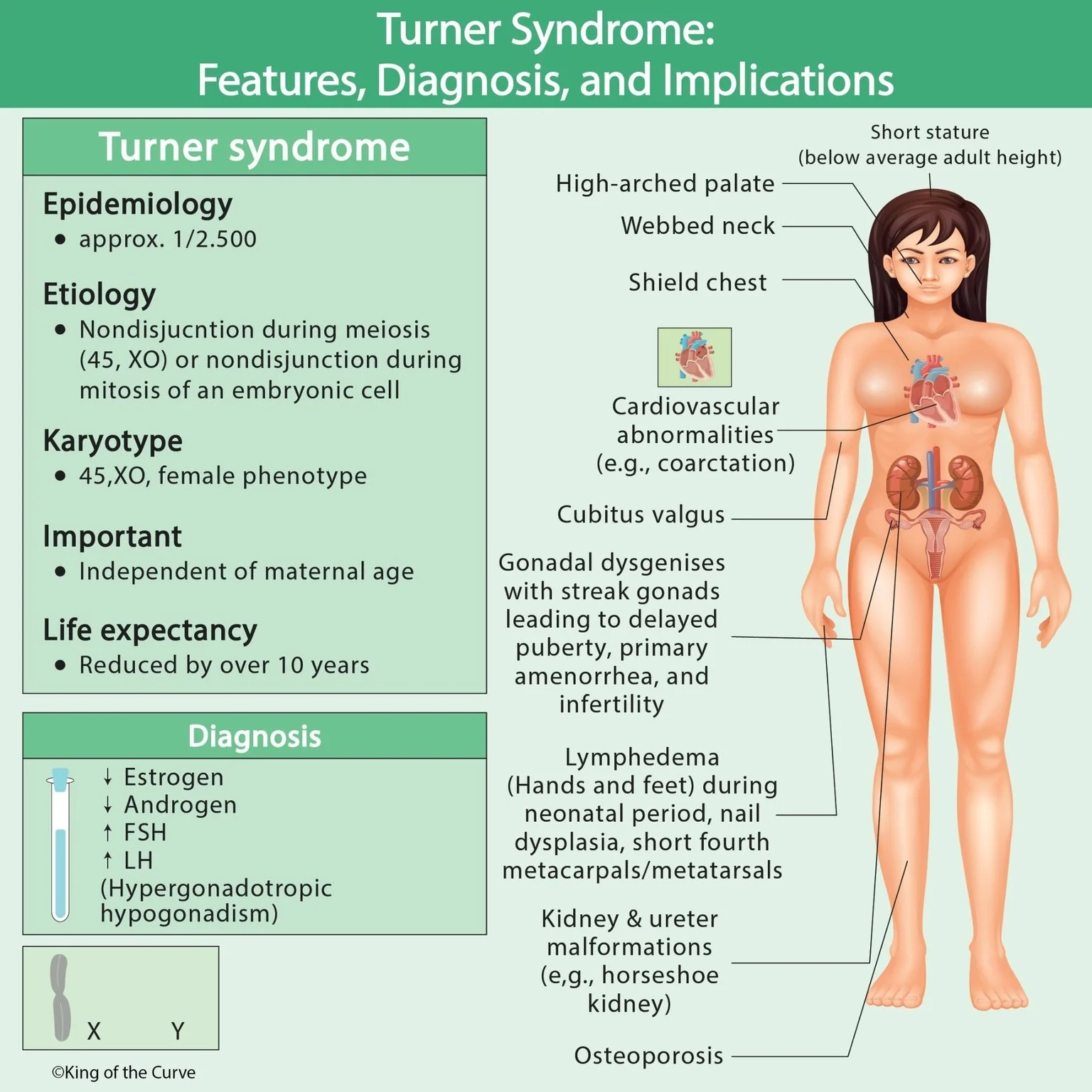 🧬 Turner Syndrome Explained: Features, Diagnosis, and High-Yield Exam Clues (45,XO)