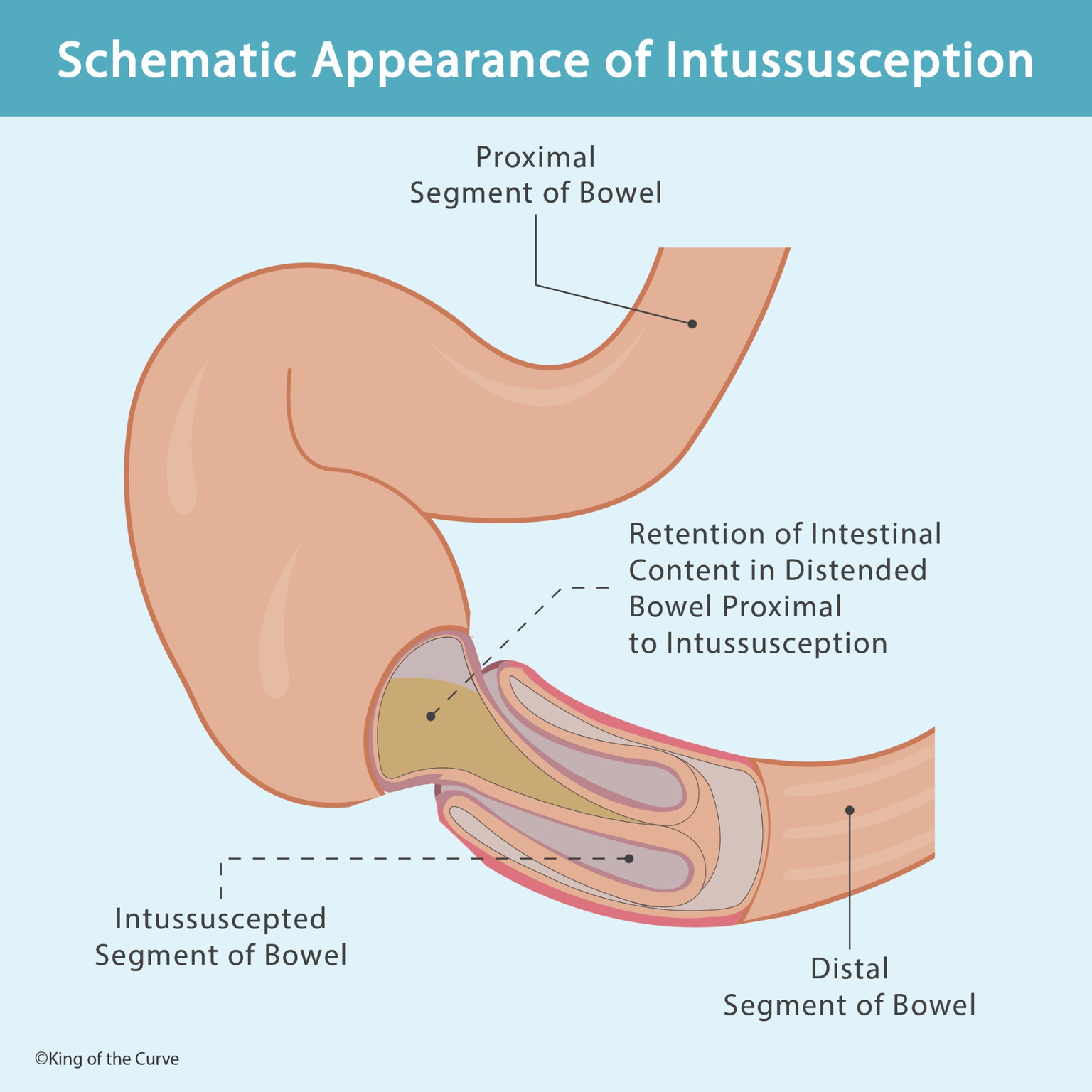 🩺 Schematic Appearance of Intussusception