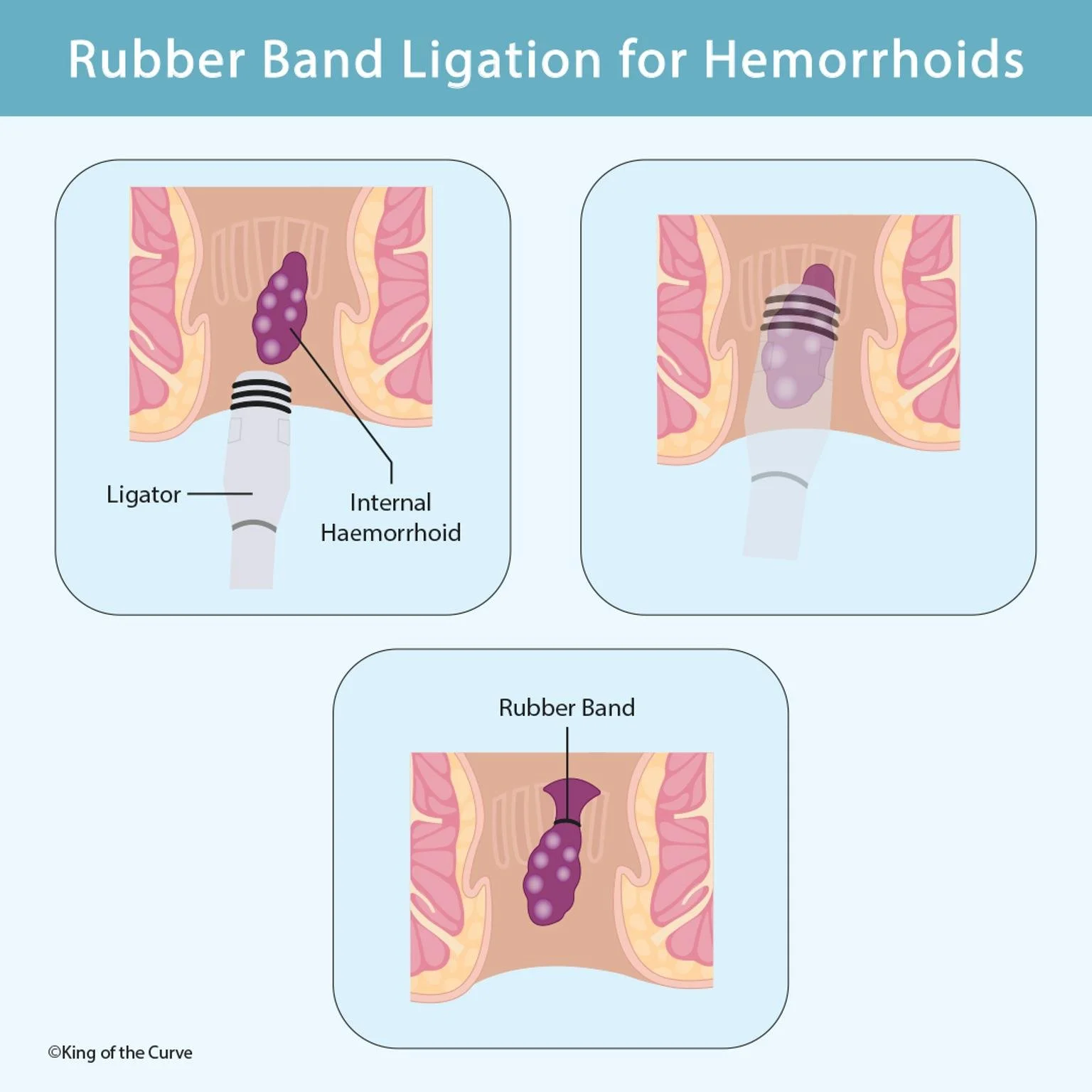 🩺 Understanding Rubber Band Ligation for Hemorrhoids