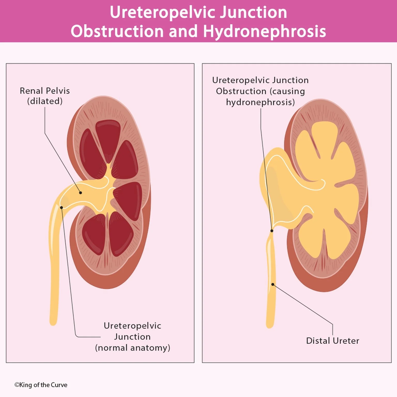 🚑 Ureteropelvic Junction Obstruction and Hydronephrosis