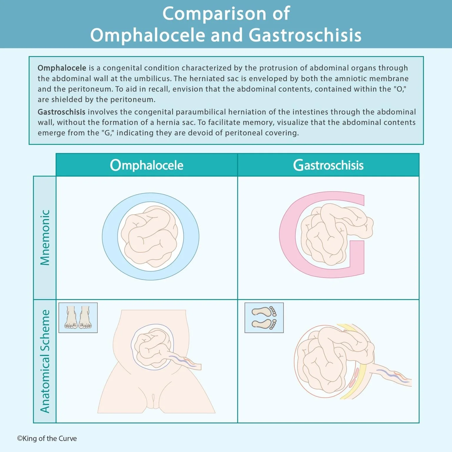 comparison-of-omphalocele-and-gastroschisis-key-differences-in