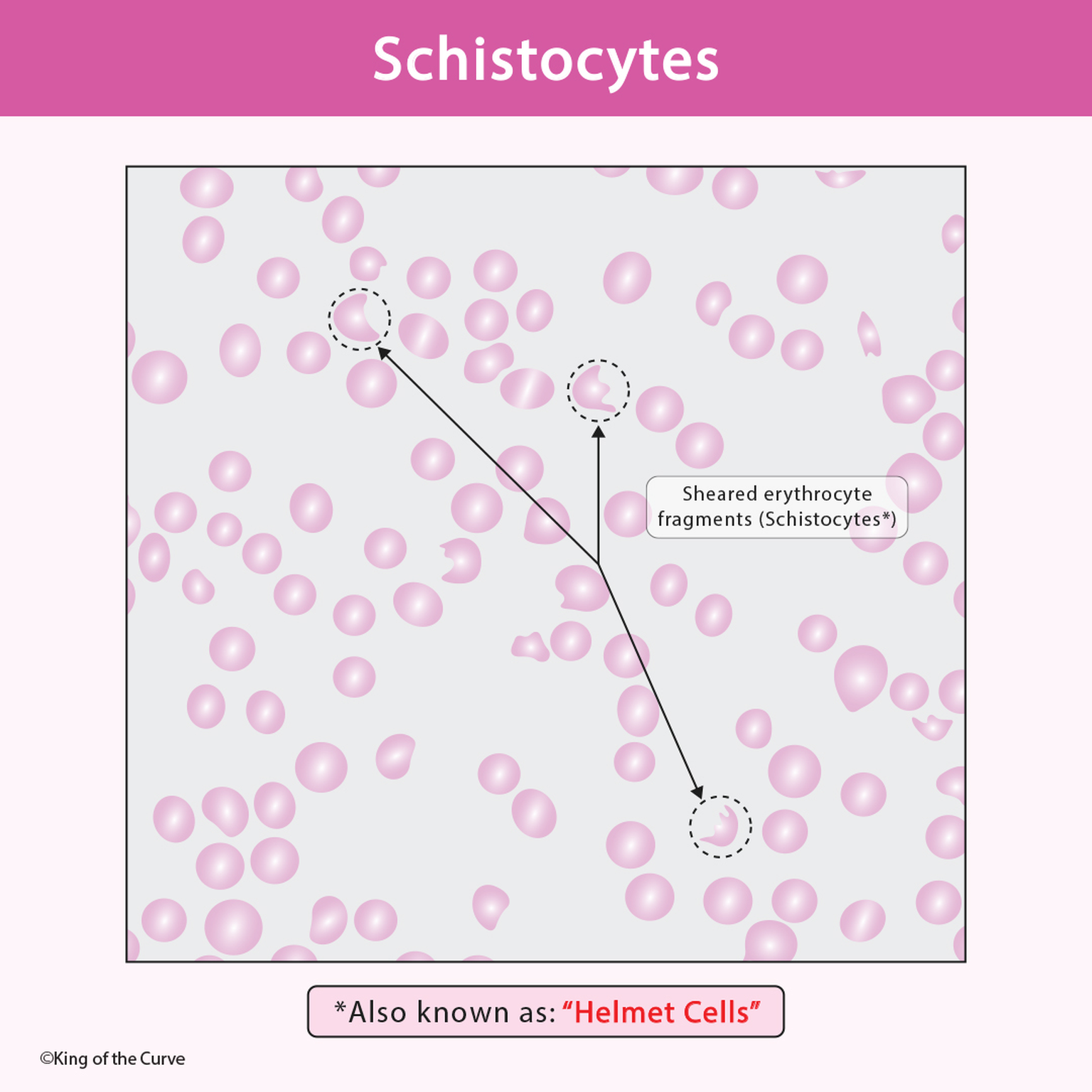 🩸 Schistocytes: What Are Helmet Cells and Why Do They Matter?