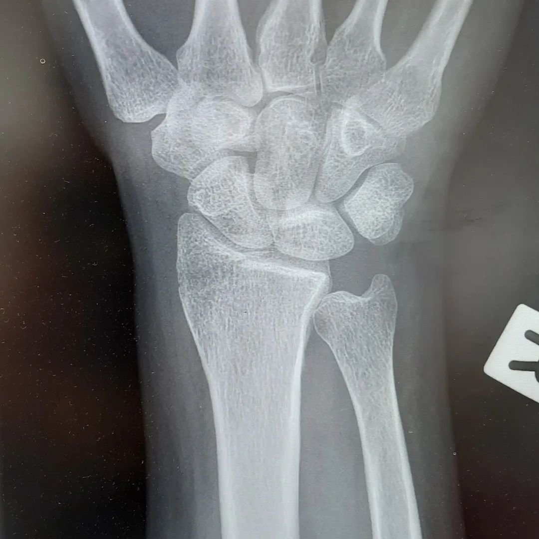 So I know I haven't posted in a minute! 😬

I've had a few things going on behind the scenes though... one of which being that I had a motorbike accident back in January and broke my wrist and ring finger MCP joint of my dominant hand. This also caus