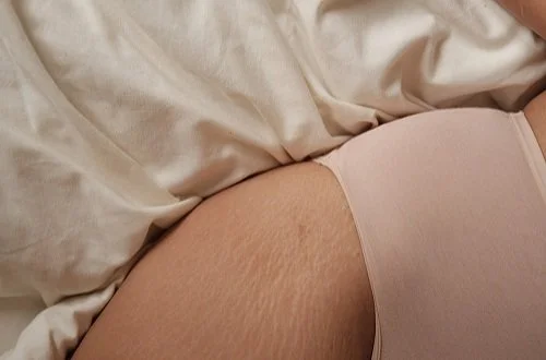 Prise de vue d'une peau avec des vergetures sur une personne allongée, habillée de vêtements de couleur beige et de sous-vêtements roses, sur un lit.