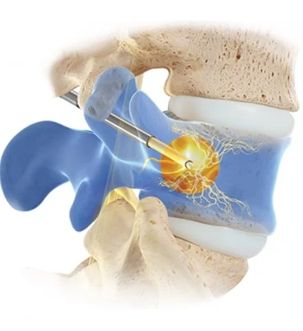 David Garas MD pain doctor Intracept procedure natick ma