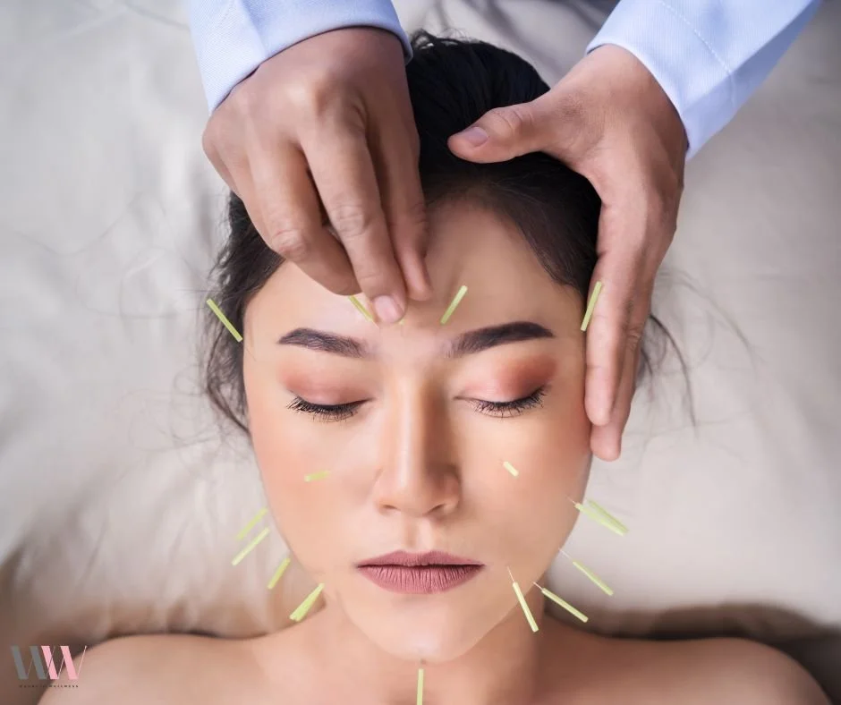 Age Gracefully with Cosmetic Acupuncture