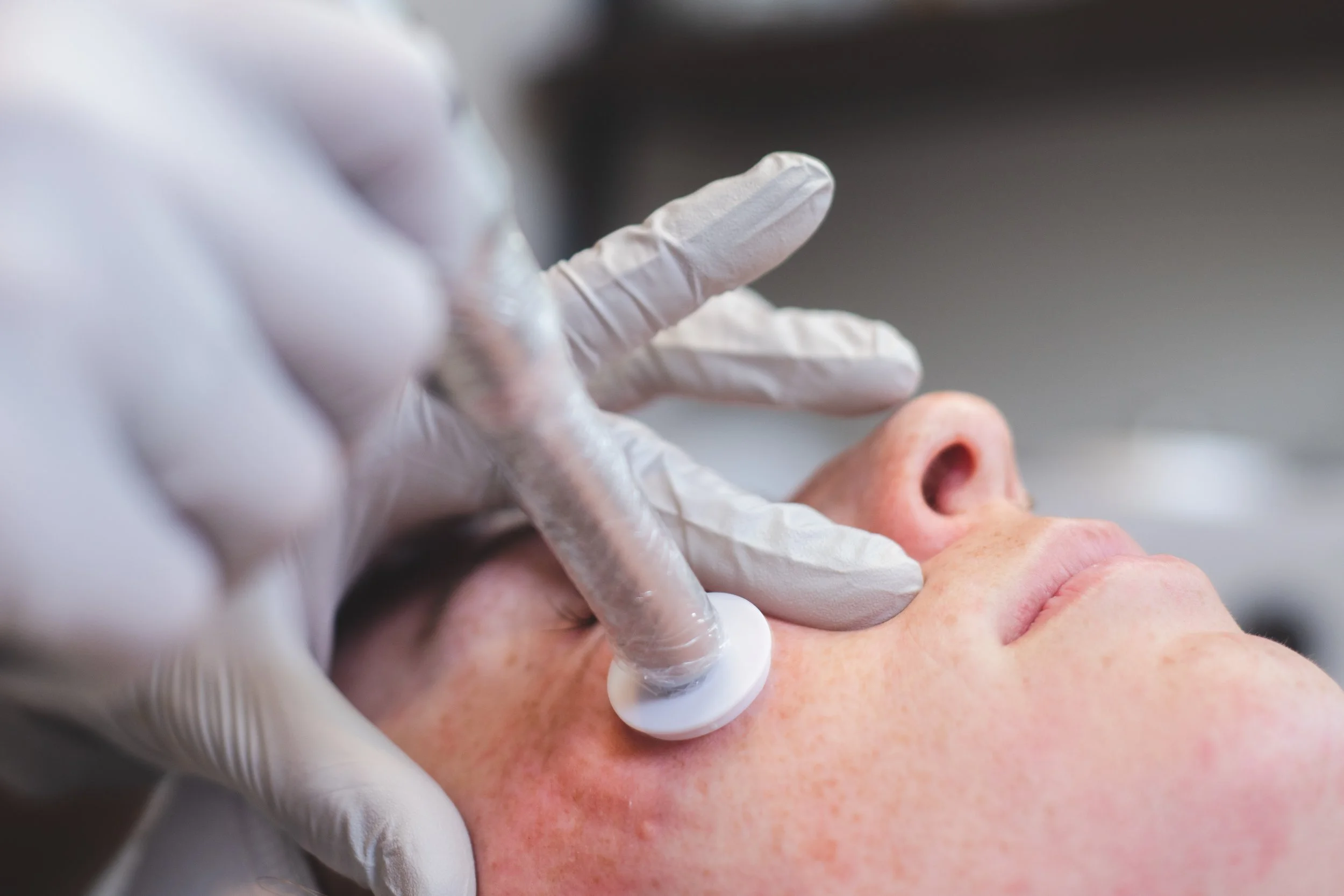 Procell Microchanneling | Revitalize Your Skin Today — Stoked Skin