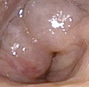 Head and Neck Lymphedema: An Underrecognized Contributor to Swallowing and Airway Impairments
