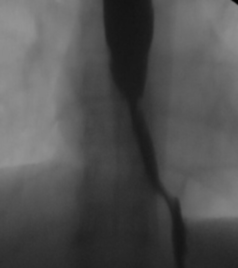 The Importance of Esophageal Screening During MBSS Performance