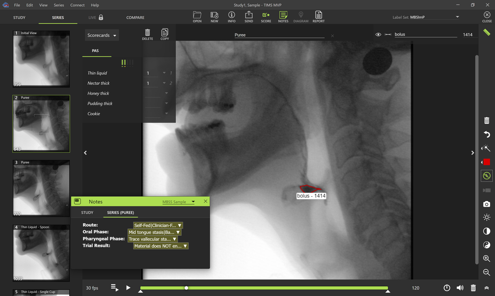 TIMS MVP for MBS | TIMS Medical