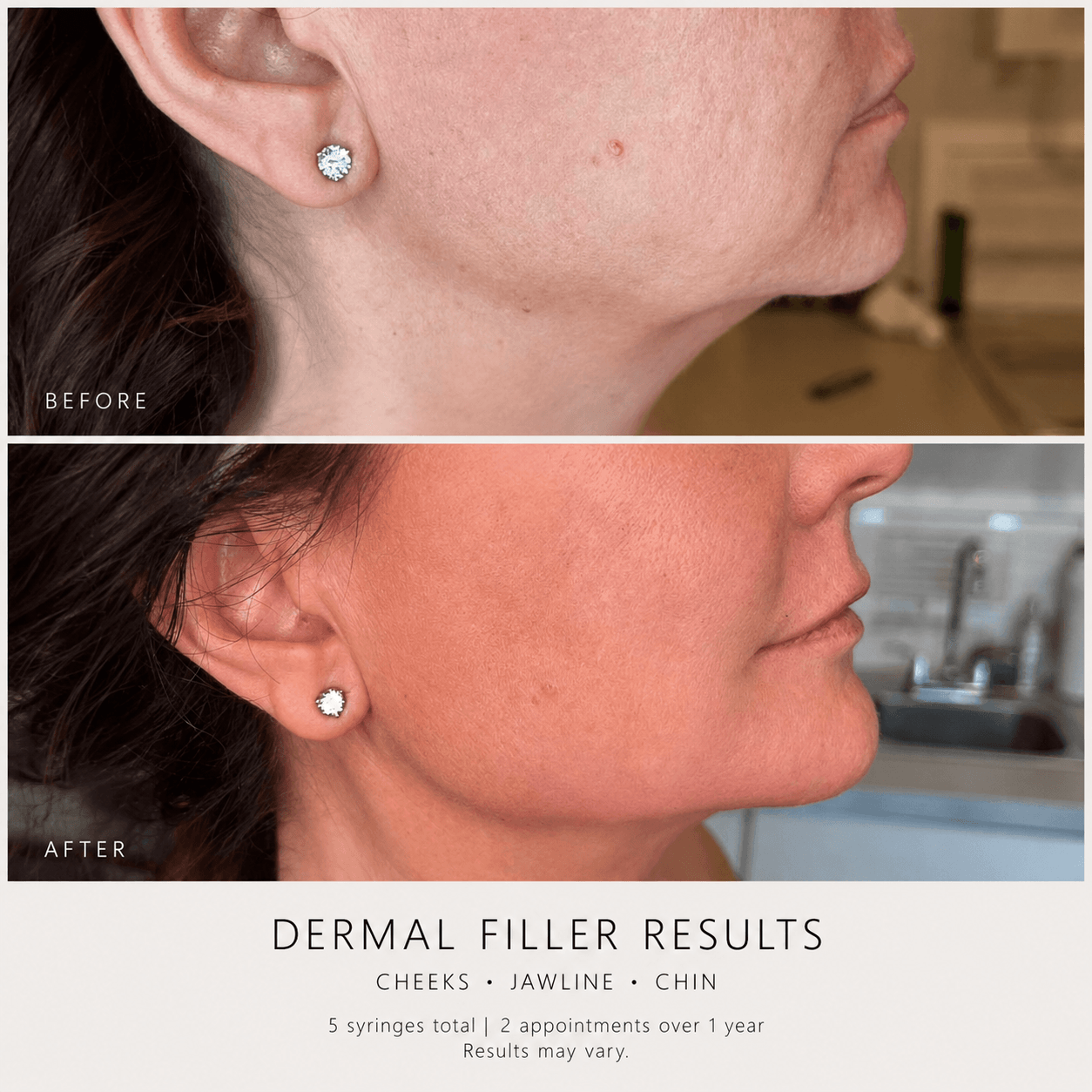 Before and after of a dermal filler client, cheeks, jawline, chin at Bombshell Aesthetics in Bedford NH 