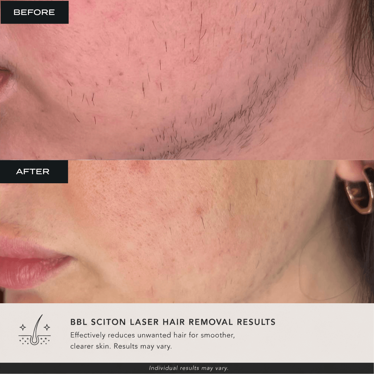 Client before and after Laser hair removal at bombshell aesthetics in Bedford nh 