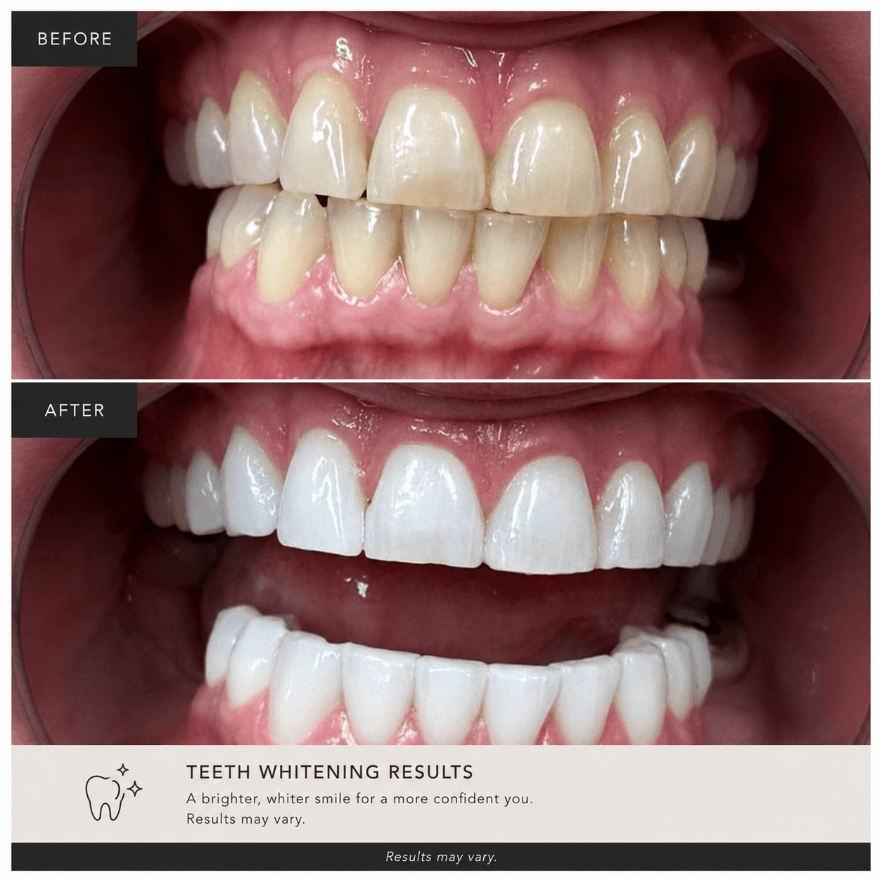 before and after from professional teeth whitening of a client at Bombshell aesthetics Bedford nh 
