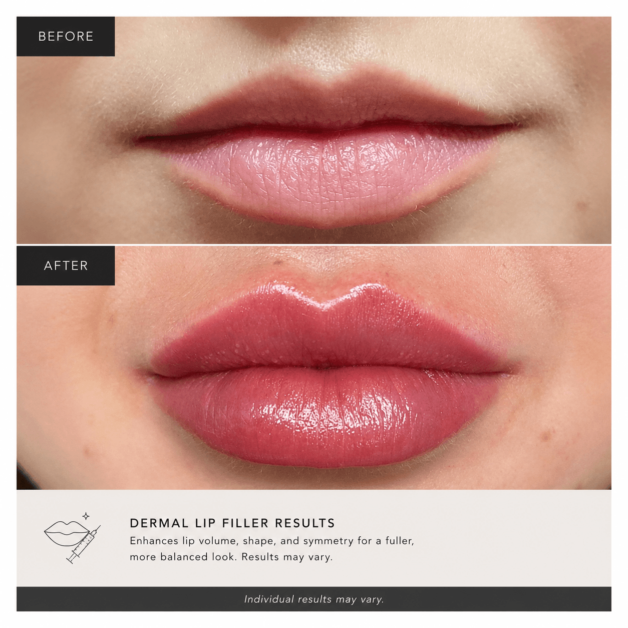 before and after of a client at bombshell aesthetics bedford nh Lip filler
