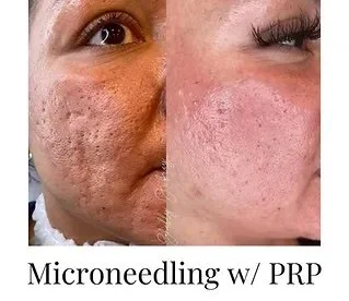Before and after images of a woman's face showing skin improvement after microneedling with PRP treatment.