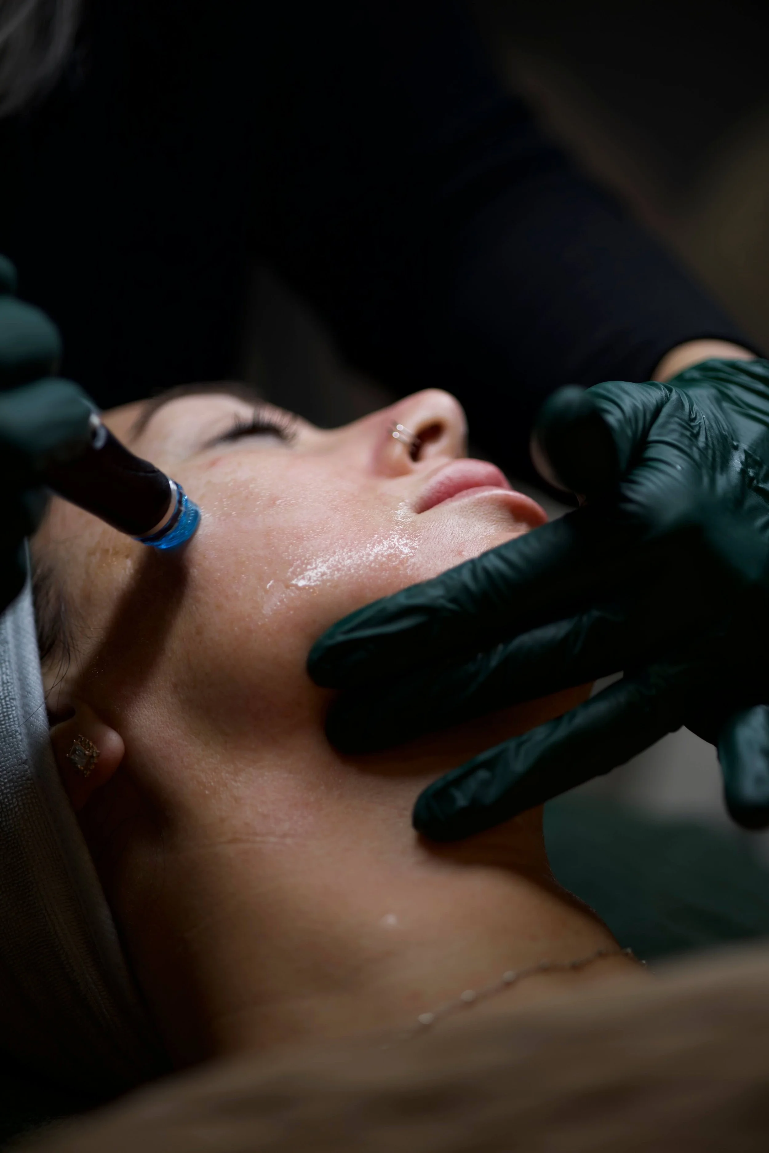 Laser hair removal treatment being performed at Bombshell Aesthetics in Bedford, NH, using Sciton BBL laser.