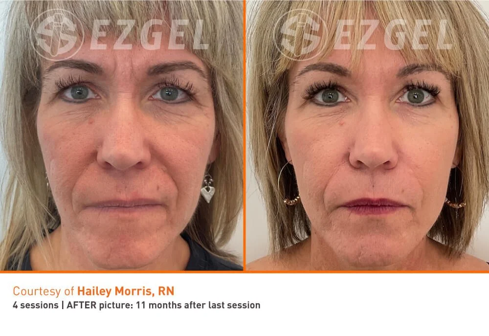 EZ PRF Treatment in Bedford, NH – Natural Skin Rejuvenation — Bombshell ...