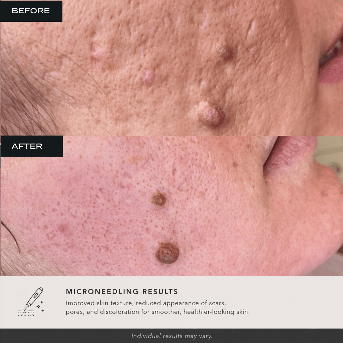 microneedling before and after results at bombshell aesthetics in Bedford nh