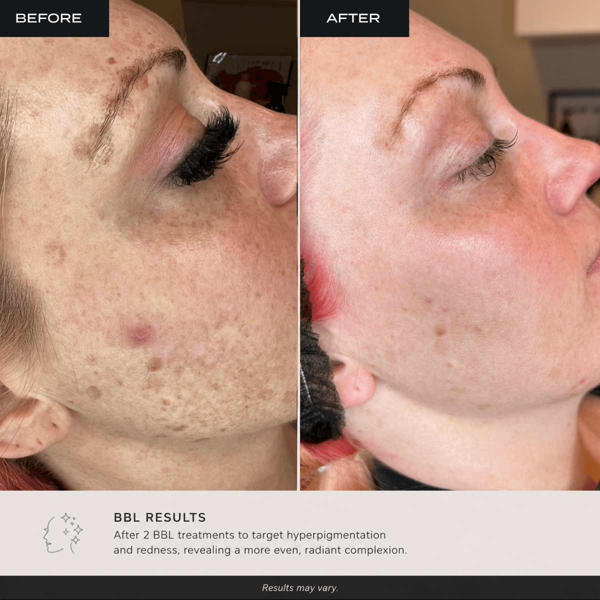 before and after of a client who received 2 BBL forever young treatmentds at bombshell aesthetics in bedford nh