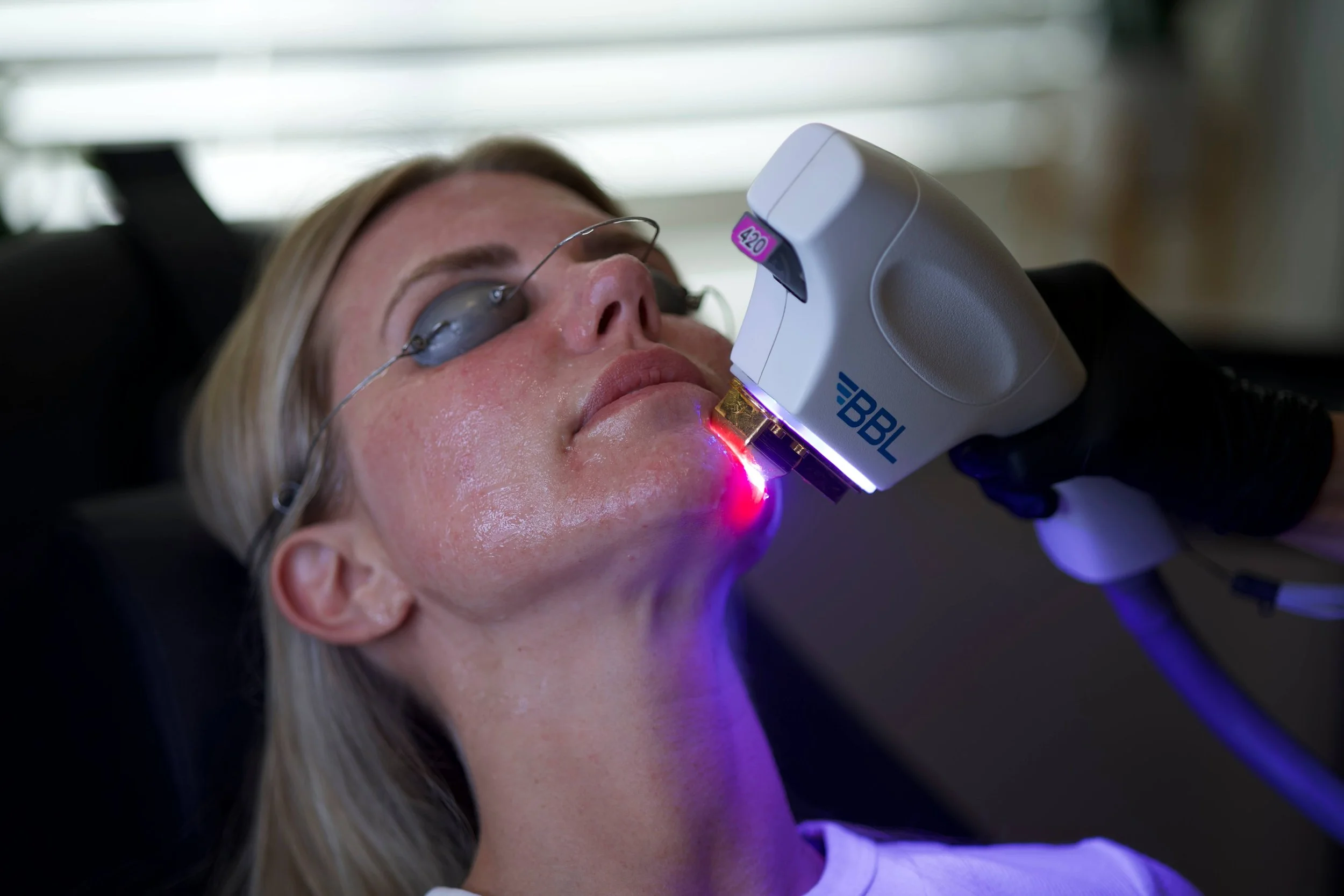 woman receiving a BBL laser treatment at Bombshell Aesthetics in Bedford, NH.
