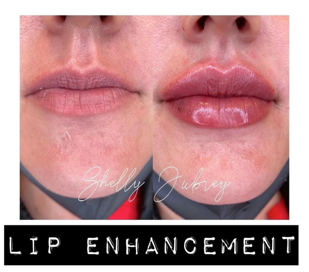 Before and after lip enhancement showing fuller lips.