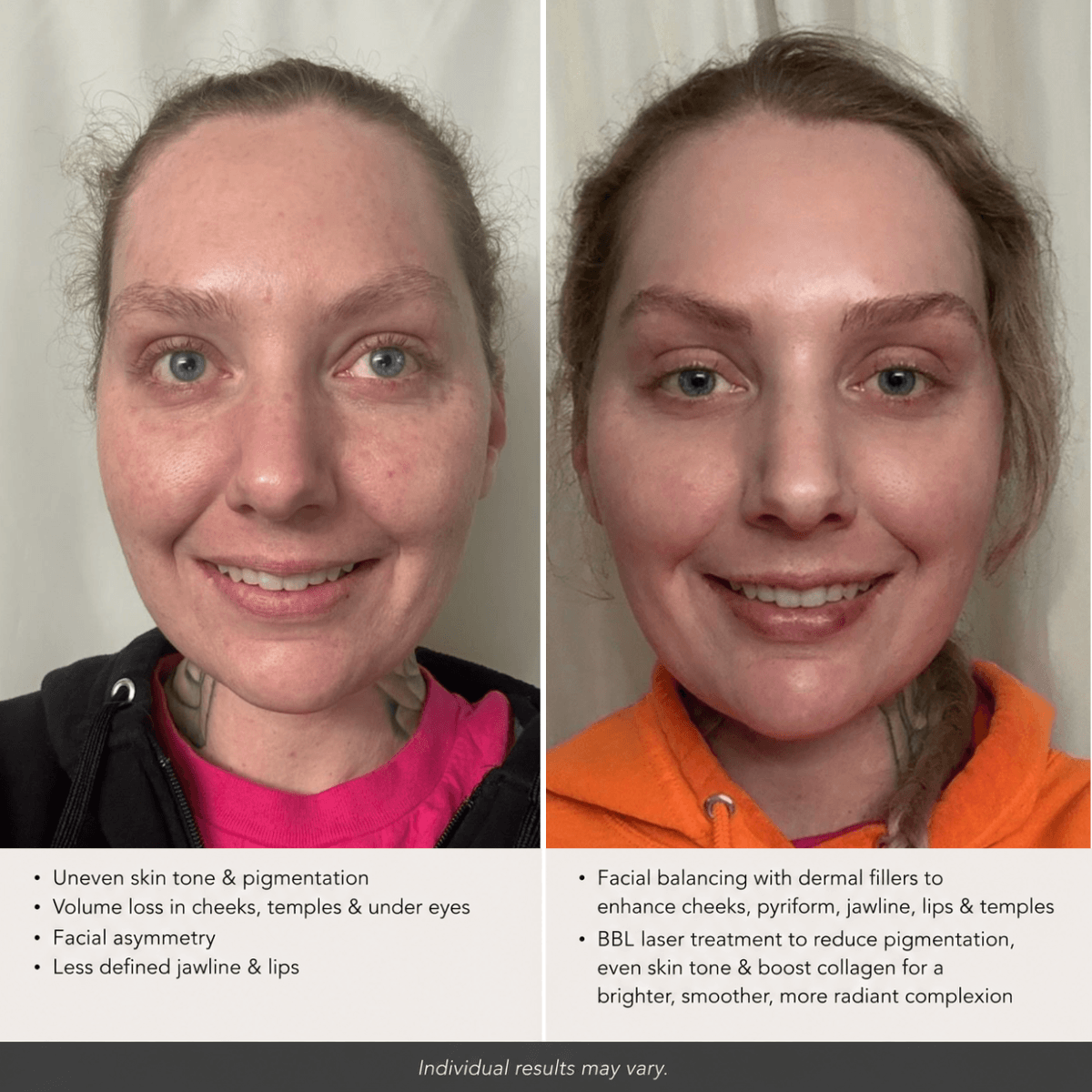 Before-and-after facial rejuvenation results showing a woman facing forward. The before image displays facial volume loss, mild asymmetry, under-eye hollowness, uneven skin tone, and pigmentation. The after image shows improved facial harmony and bal