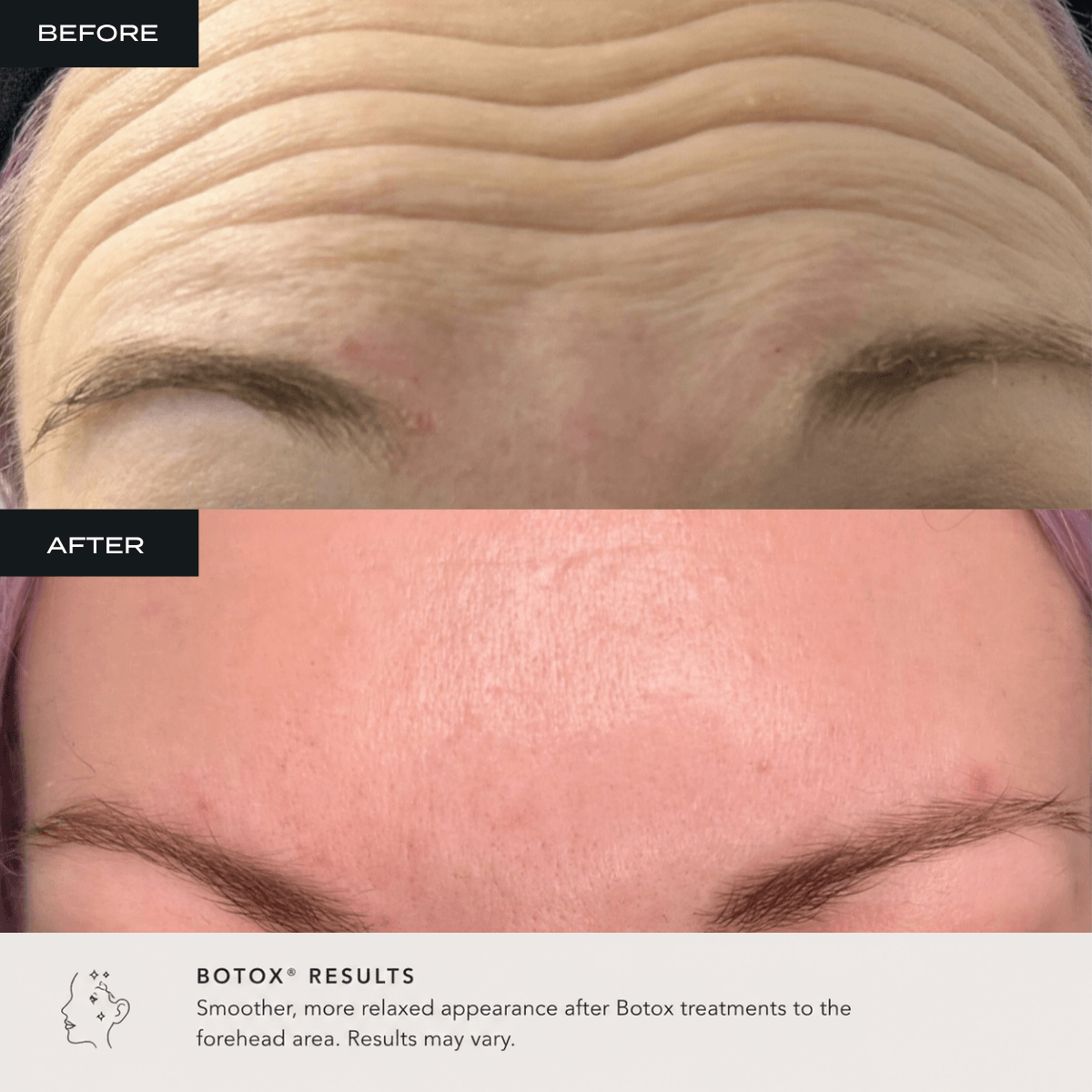 Botox before and after of a client at bombshell Aesthetics in Bedford NH