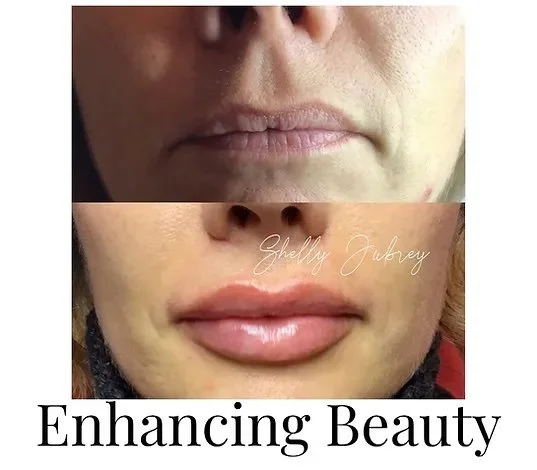 Before and after lip enhancement comparison showing fuller lips in the lower image, with text "Enhancing Beauty."