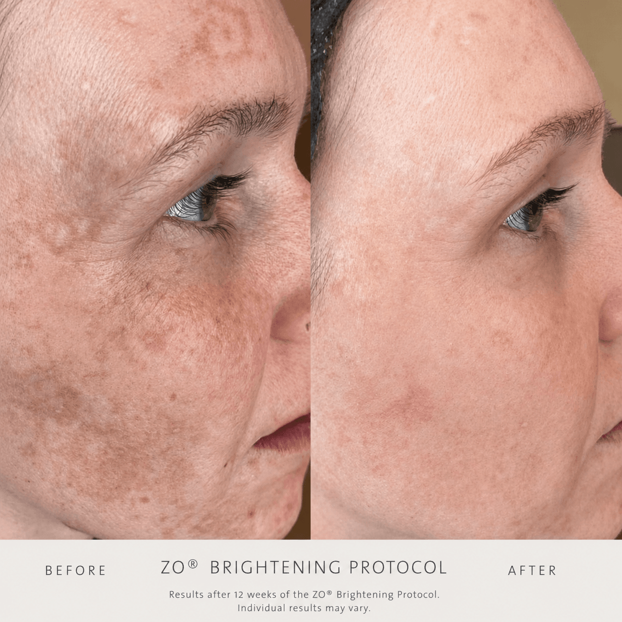 before and after of a client at Bombshell Aesthetics in Bedford NH ZO skin health Brightening protocol