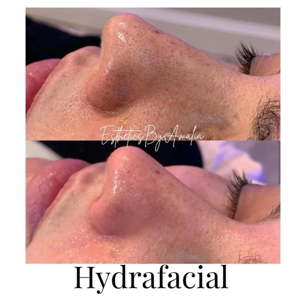 Before and after Hydrafacial treatment showing clearer skin on the nose.