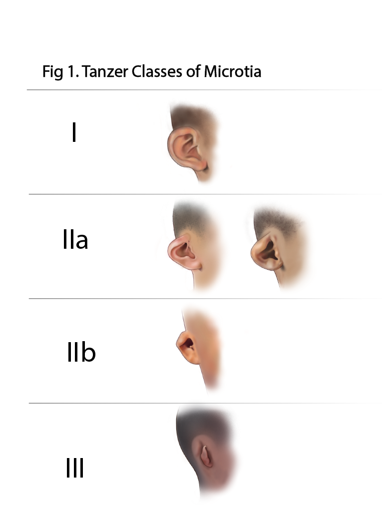 Tanzer Classes of Microtia. May 2025. 