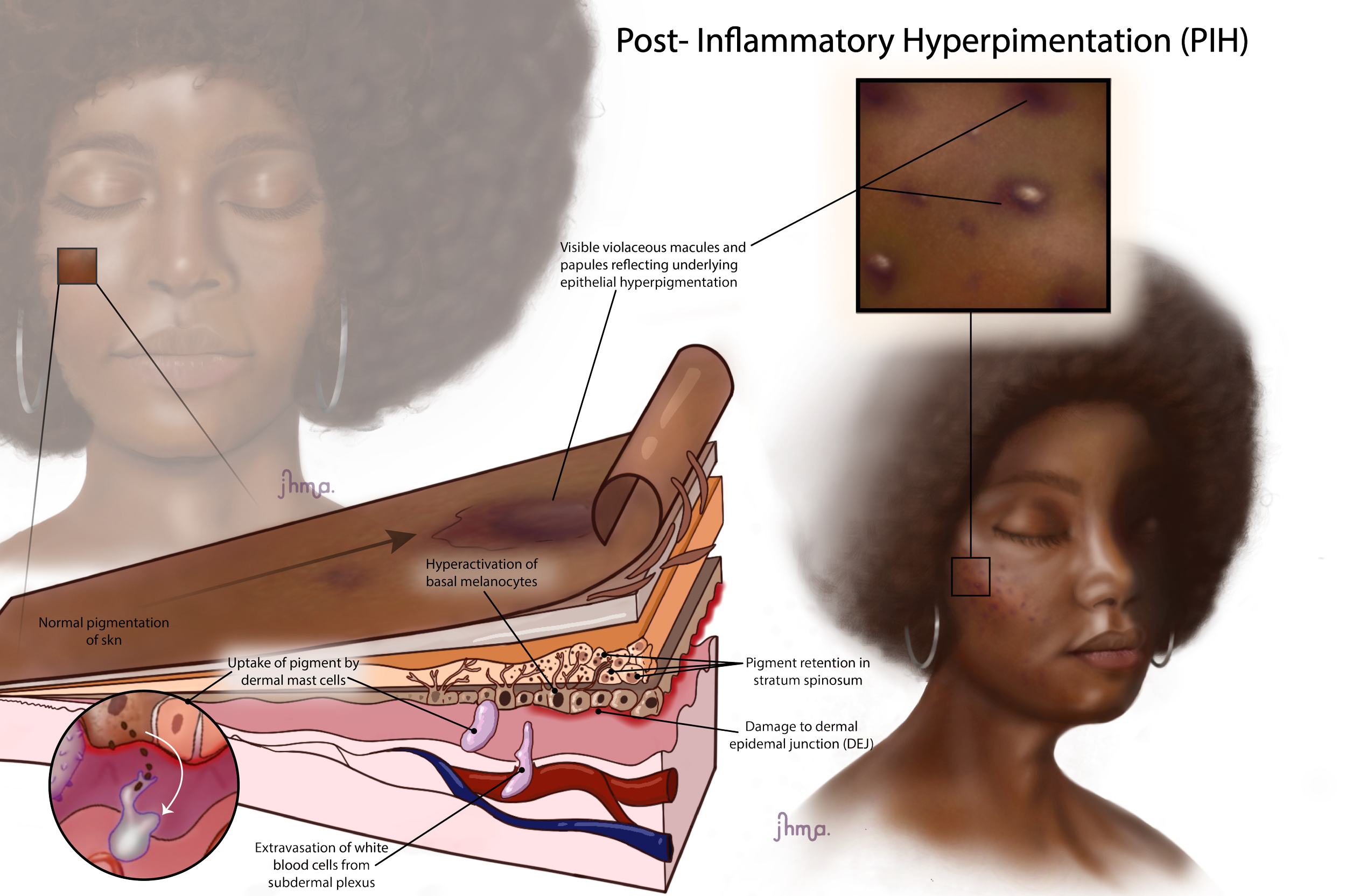 Post-Inflammatory Hyperpigmentation. Commissioned for "Brown Skin Matters: The Print Edition". 2026 January 28.