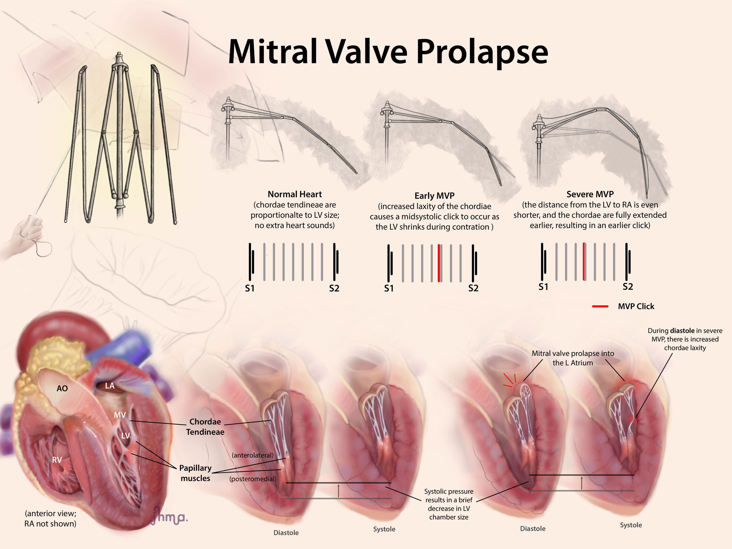 Mitral Valve Prolapse. April 2025
