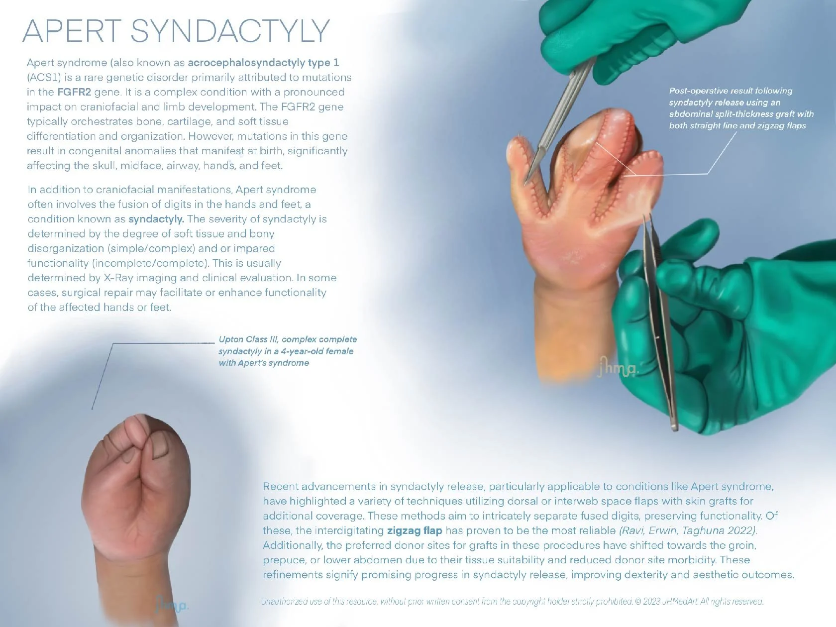 Apert Syndactyly. June 2023. 