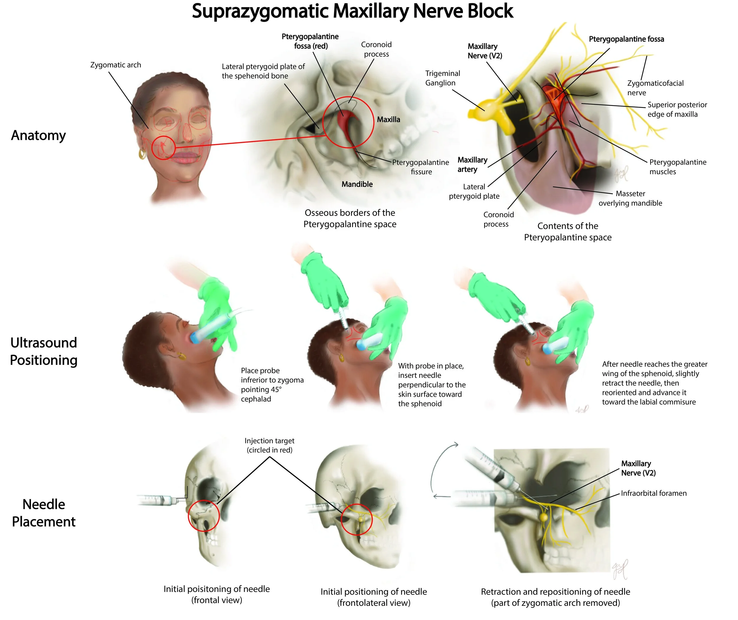 Suprazygomatic Maxillary Nerve Block. April 2024. Published in Plastic and Reconstructive Surgery.  2025 Jan 28. (click to access publication)