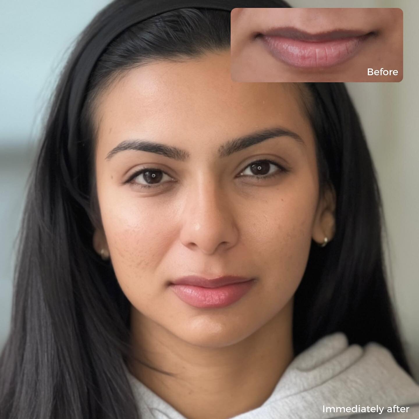 Natural beauty 🤍 

Lifting hyperpigmentation, creating an even tone and a natural tint of colour with lip blush neutralization 👄

These gorgeous will last 3+ years &mdash; touch ups are recommended every 1-2 to maintain results 🤞🏼

Click link in 