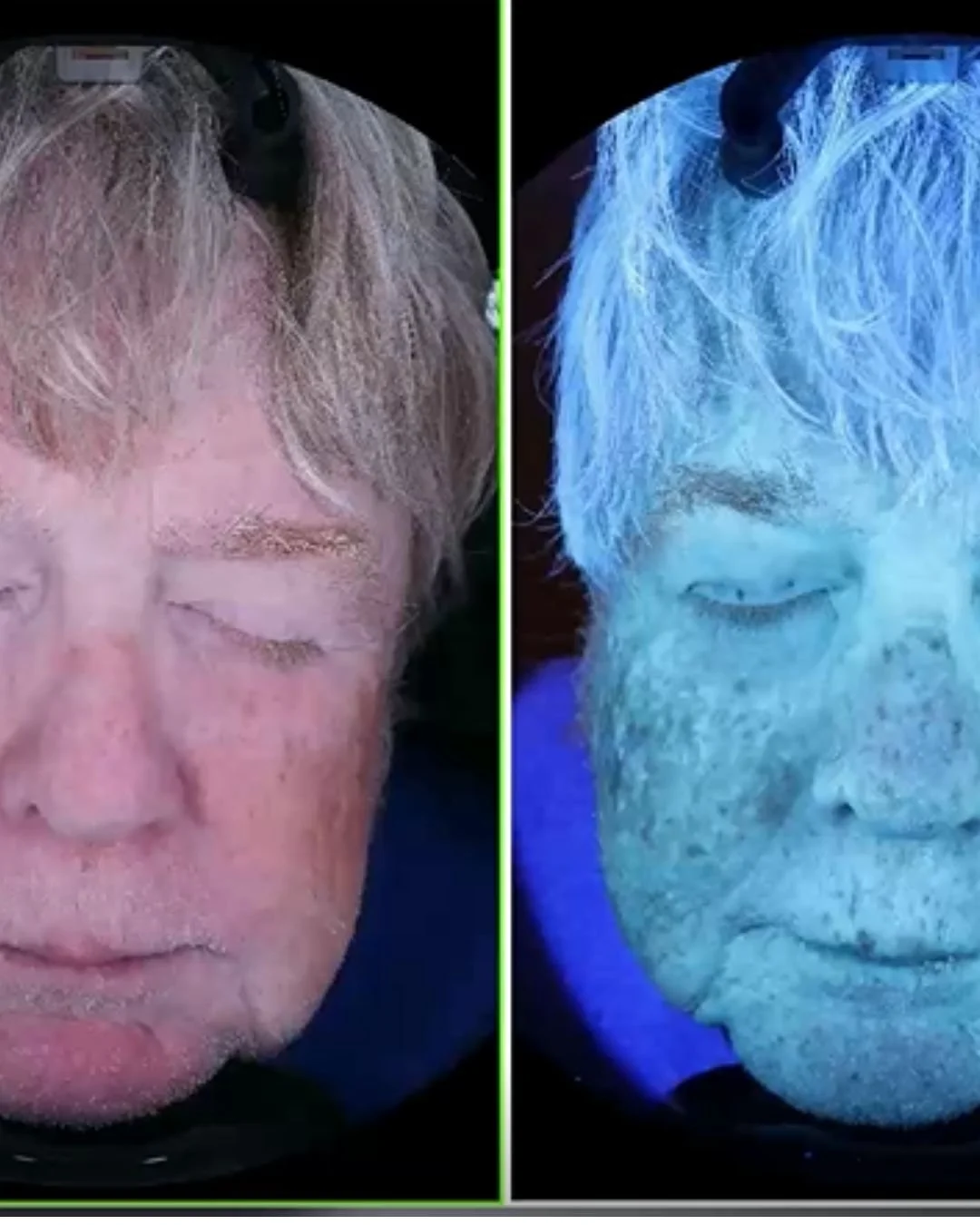 Split screen image of a woman with closed eyes, shown under a normal light on the left and under a UV light on the right, revealing different skin textures.