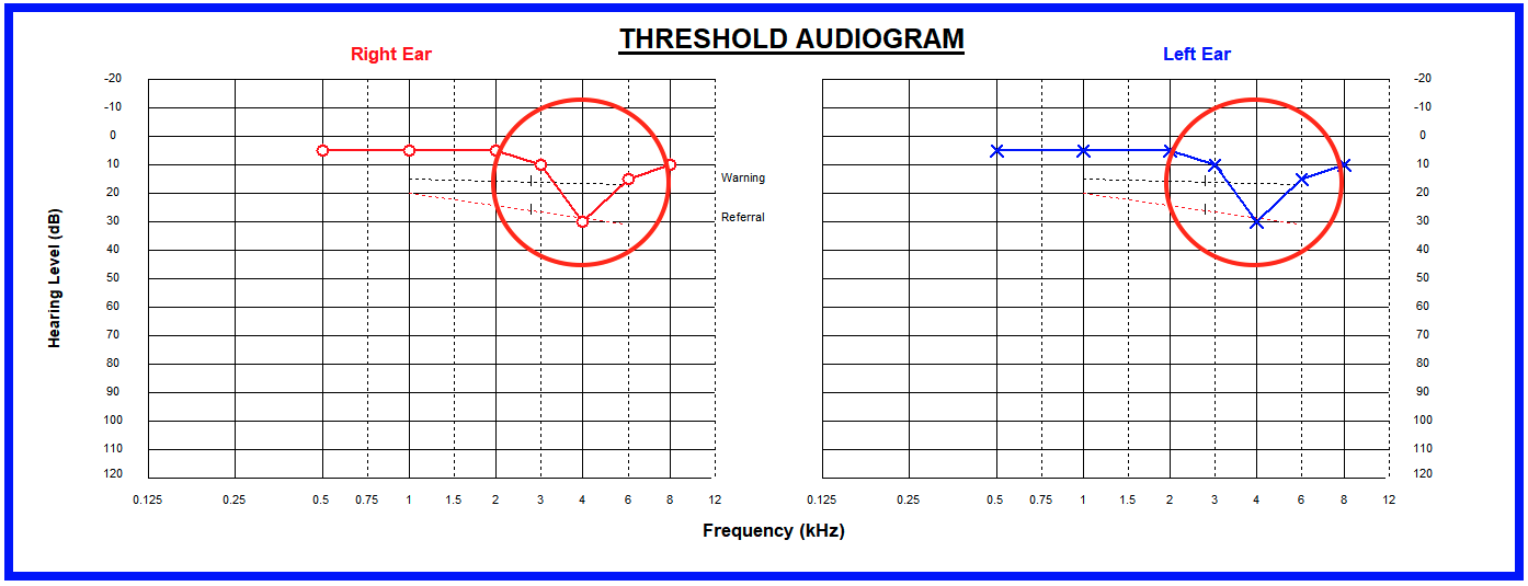 A hearing test result graph showing some slight losses in the high frequencies - a v shaped dip on the right hand side