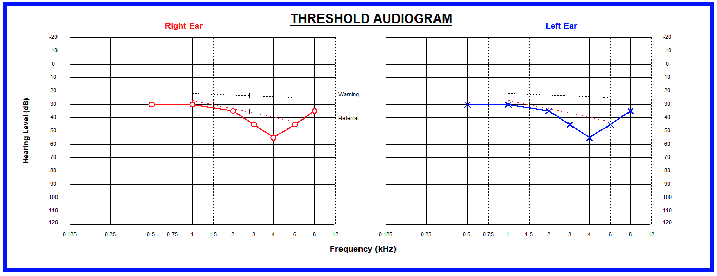 A hearing test result graph showing reduced hearing at all frequencies. The lines are across the middle of the graph rather than at the top.