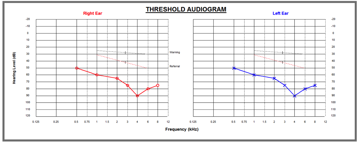 A hearing test result chart showing heavy hearing loss - the lines are low down on the chart