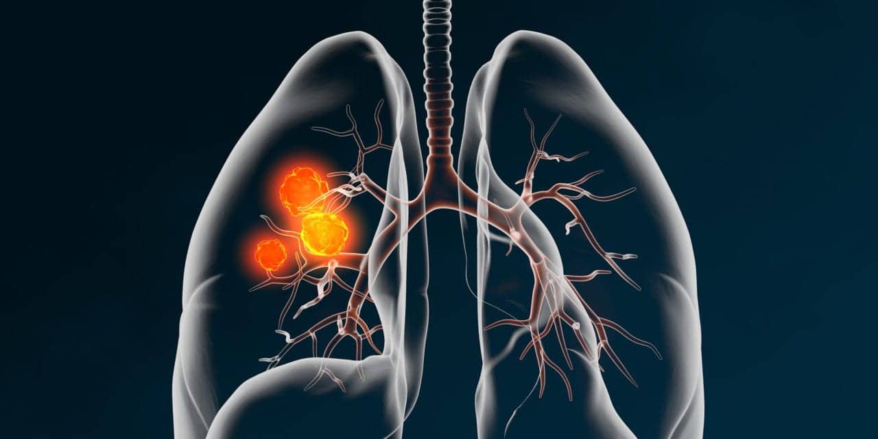 THIO Followed by Cemiplimab Shows Early Promise in Advanced NSCLC