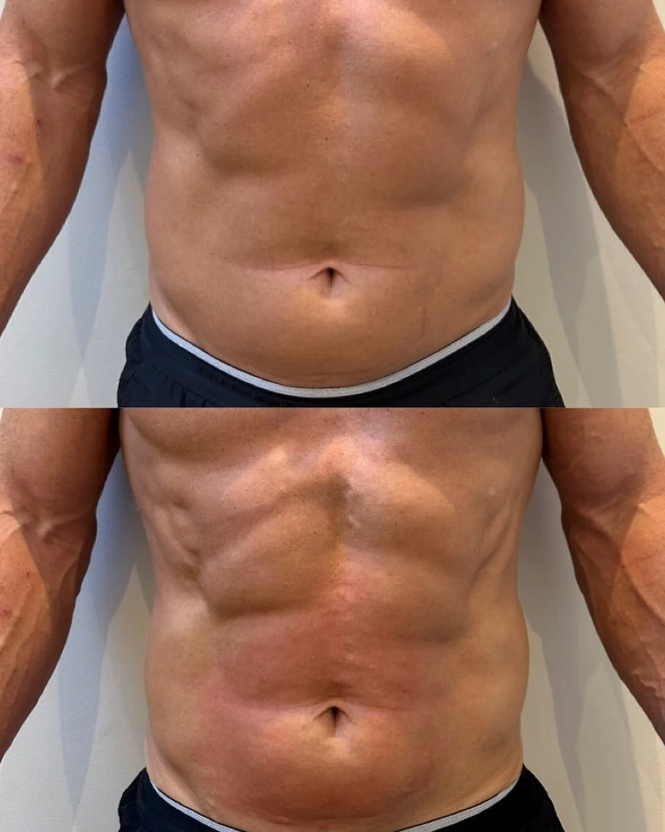 2x fat cavitation + 1x RF skin tightening completed on the stomach 💭 

#fatcavitation #perthclinic #health #wellness #abs #rfskintightening #skintightening #bodysculpting #aesthetics #aesthetic #summer #bodycontouring #bodycontouringperth #bodysculp