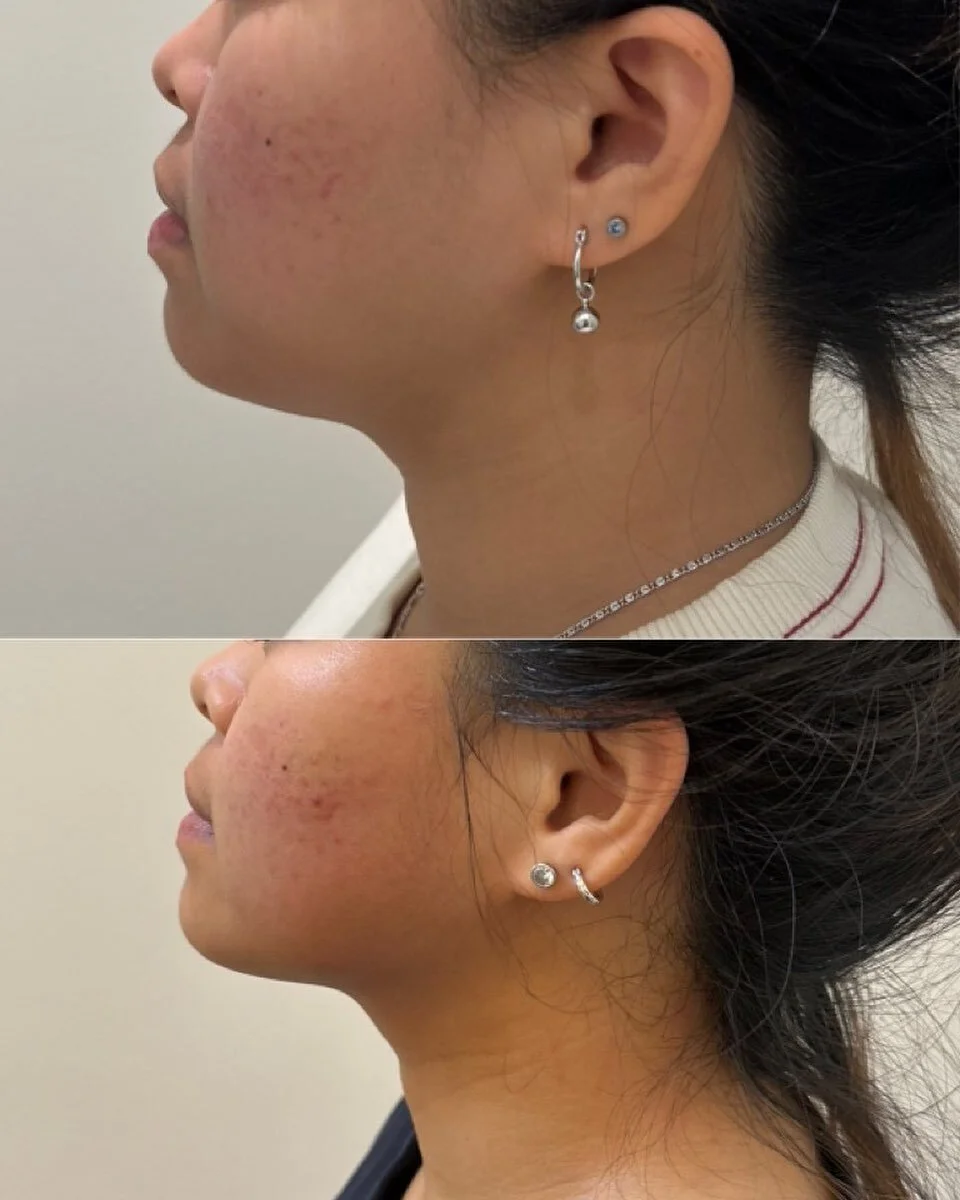 2x jawline treatments completed ✅ 

Hello defined jawline 🤩 

#jawlinecontouring #rfskintightening #fatcavitation #fatcavitationperth #bodycontouring #bodysculpt #bodycontouringperth #jawline #health #wellness #aesthetics #love #summer #client #pert